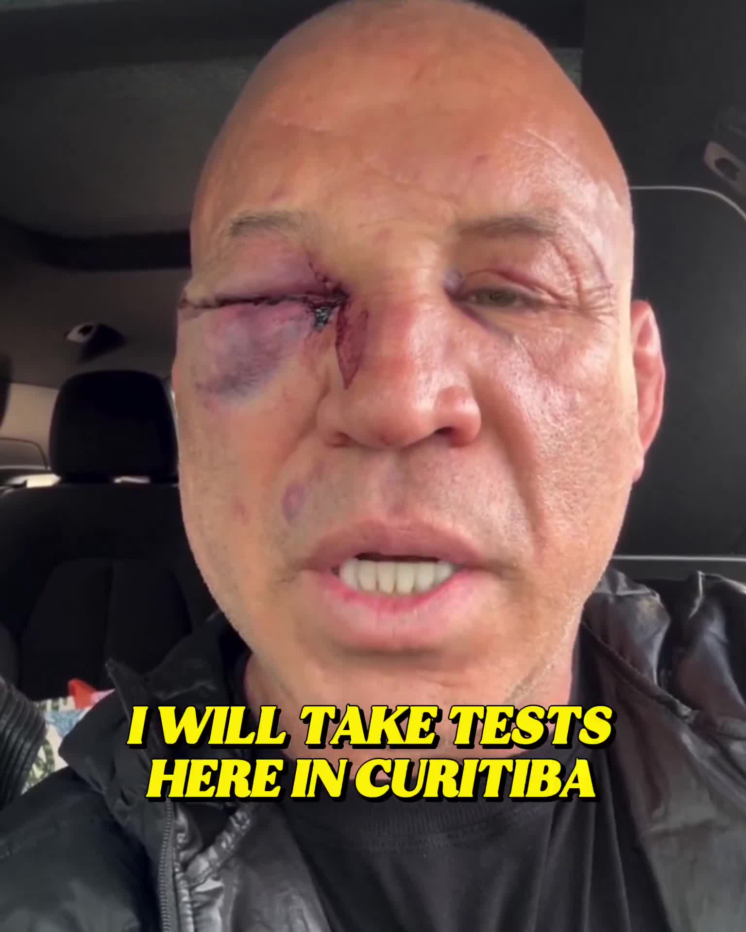 Wanderlei Silva suffered a broken nose and “serious headaches” after getting KO’d in a brawl during his boxing match last night