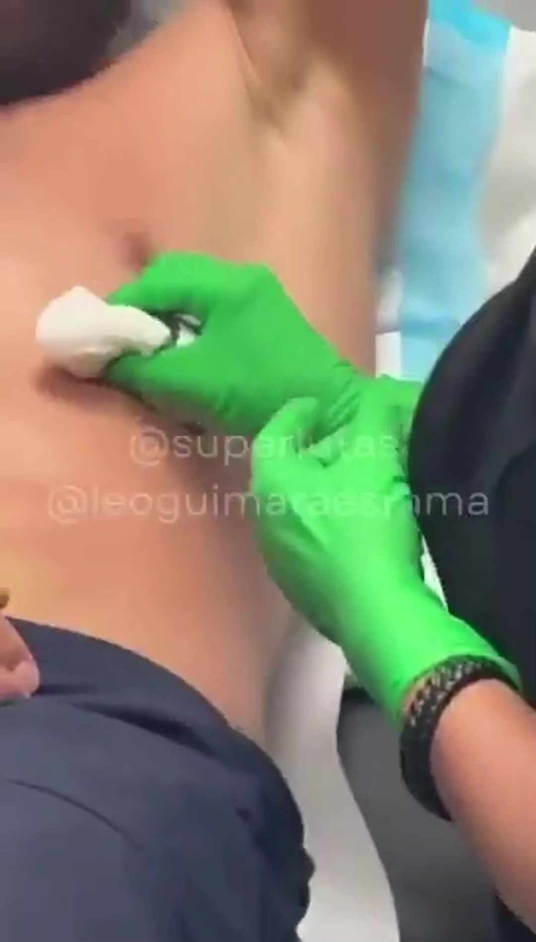 Video shows Magomed Ankalaev had a broken rib 20 days prior fighting Alex Pereira at UFC 320. (2)